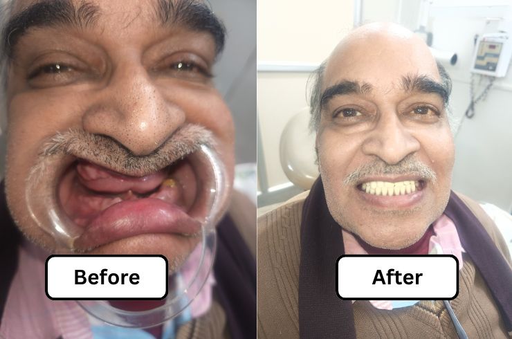 Complete Dentures